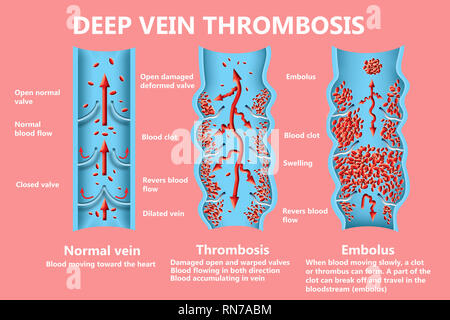 Thrombose. Von den normalen Blutfluss zu Blutgerinnsel Stockfoto