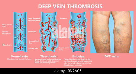 Tiefe Venenthrombose oder Blutgerinnsel. Embolus. Stockfoto