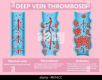 Thrombose. Von den normalen Blutfluss zu Blutgerinnsel Stockfoto