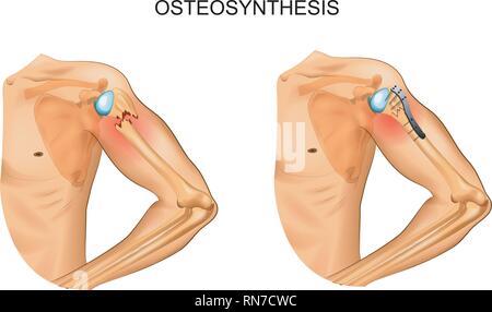 Vector Illustration der Osteosynthese in der Bruch der Humeruskopf Stock Vektor