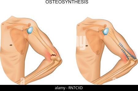 Vector Illustration der Osteosynthese bei Frakturen des distalen Humerus Stock Vektor