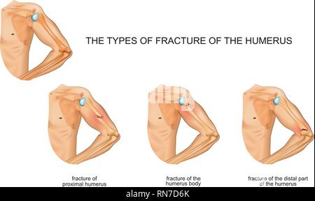 Vector Illustration des humerus Bruch, Traumatologie, Chirurgie Stock Vektor