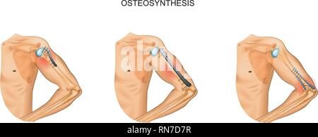 Vector Illustration der Osteosynthese des Humerus Stock Vektor