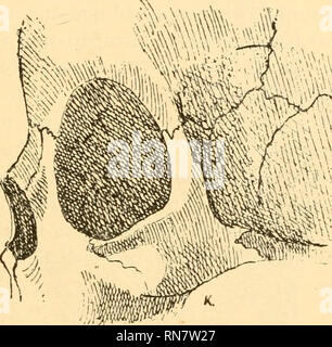 . Anatomischer Anzeiger. Anatomie, Vergleichende; Anatomie, Vergleichende. 403 Springer und Schwalbe fanden-viel häufiger (78,9%), als der entgegengesetzte Fall (21,1 %). Eine typische Fontaneila metopica / Schwalbe kam in 2 Fällen vor und zwar einen etwa 8 - 9 monatlichen Fetalschädeln, 5/6 sterben Überbleibsel of this Fontanelle in Form unregelmäßiger Medianspalten Schädeln eines Erwachsenen nur in einem Falle (0,2%) zu sehen waren. Of this Schädel (Abb. 3) scheint ungefähr 50 Jahre alt zu sein, und die erwähnte Bildung Balatonfüred im unteren Sechstel der Bogenlänge des Stirnbeins (84,6% der Bogenlänge fällt Stockfoto