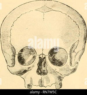 . Anatomischer Anzeiger. Anatomie, Vergleichende; Anatomie, Vergleichende. 401 sekundäres supranasales Dreieck, ein zwei Schädeln von Erwachsenen ebenfalls ein (unter 452 = 0,4%) supranasaler Streifen von. Abb. 1. Nahtknocheu in der untersten, nasalen Nebenklägerin der Stirnnaht. t^CHWALBE zu sehen. Der eine von diesen letzteren ist ein Männer-Schädel (Abb. 2) zwischen 40 - 50 Jahren. Die letzten Spuren des''^^ kt,!#l) ife^'l": t. Bitte beachten Sie, dass diese Bilder aus gescannten Seite Bilder, die digital für die Lesbarkeit verbessert haben mögen - Färbung und Aussehen dieser Abbildungen kann nicht extrahiert werden Stockfoto