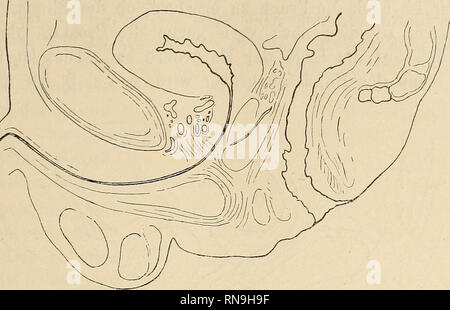 . Anatomischer Anzeiger. Anatomie, Vergleichende. 255. Abb. 2. (S a. Nr. 17) sehen kann, in welchen die Krümmungslinien einander sehr ähnlich sind. Ist dagegen die Blase voll, dann sieht man, dass sie von Ihr Browser kann leider keine eingebetteten Frames anzeigen Ihr in Prostata und Harnröhre drückt. Die Erstere wird flach, die letztere wird verkürzt. Bei sehr starker Blasenfüllung, wie sie sich in den Abbildungen von fehleisen (s a. Nr. 14) und Rüdinger (s a. Nr. 19)^ Bürsten, ist übereinstimmend der eine Teil der Harnröhre förmlich ab-geknickt und / hin-/^^ Nr. 10 flach gelegt, 5/6 für die Lage der Pars mem-branacea und Gleichheiten ex-trapelvina v Stockfoto