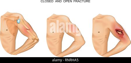 Vector Illustration von offenen und geschlossenen Frakturen Stock Vektor