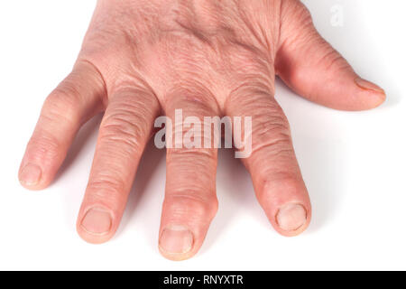 Rheumatoide polyarthritis der Hände auf weißem Hintergrund. Stockfoto