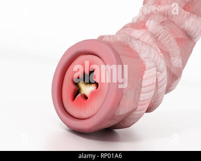 Bronchialen Schlauch Abbildung, die Asthma behindert. 3D-Darstellung. Stockfoto