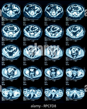 Die Magnetresonanztomographie (MRT) der Brust und Bauch Stockfoto