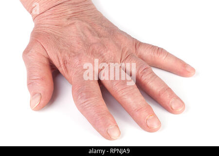 Rheumatoide polyarthritis der Hände auf weißem Hintergrund Stockfoto