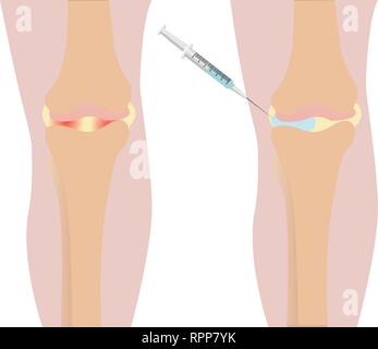 Knie Injektion Entzündung vor und nach der Injektion zu verletzten Knie Vector Illustration Stock Vektor