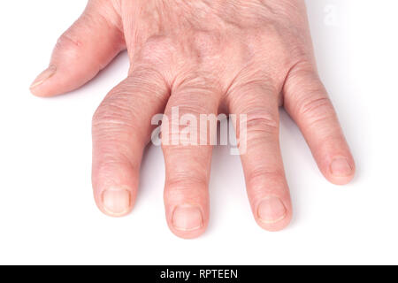 Rheumatoide polyarthritis der Hände auf weißem Hintergrund Stockfoto