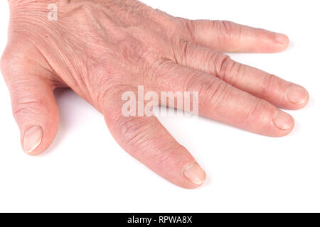 Rheumatoide polyarthritis der Hände auf weißem Hintergrund Stockfoto