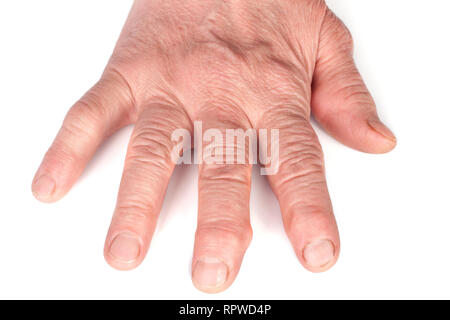 Rheumatoide polyarthritis der Hände auf weißem Hintergrund Stockfoto