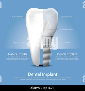 Menschlichen Zähnen und zahnmedizinische Vektor-illustration Implantat Stock Vektor