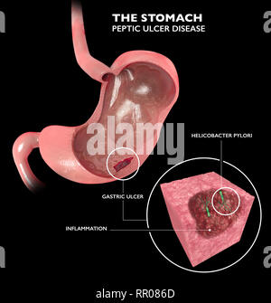 Abschnitt 3 d des Magens. Peptisches Magengeschwür, Magengeschwür ist ein Bruch in der inneren Auskleidung des Magens. Helicobacter pylori Stockfoto