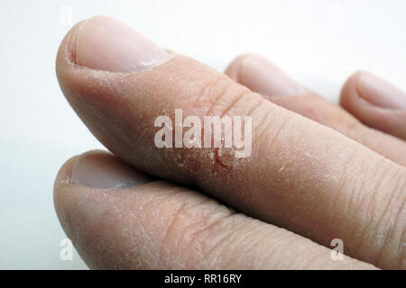 Trockene Haut auf den Fingern geknackt. Arme mit Dermatologie Probleme. Stockfoto