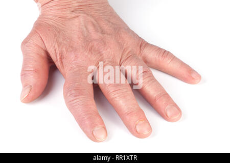 Rheumatoide polyarthritis der Hände auf weißem Hintergrund Stockfoto