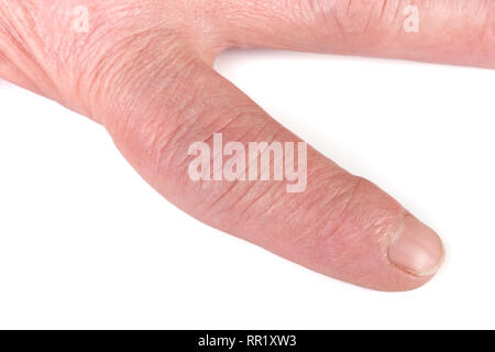 Rheumatoide polyarthritis der Hände auf weißem Hintergrund Stockfoto