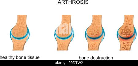 Vector Illustration von Arthrose. Zerstörung von Knochengewebe Stock Vektor