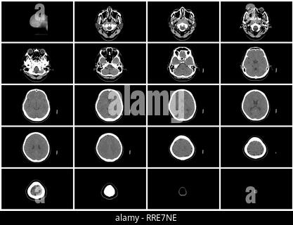 Ct-scan Schritt Satz oberer Gehirn Kopf axiale Ansicht von oben Stockfoto