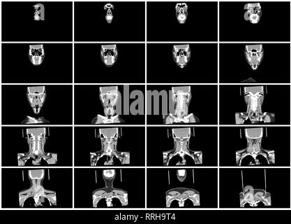 Ct-scan Schritt Einstellen des Halses koronalen Ansicht Stockfoto