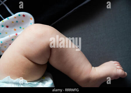 Bis auf die atopische Dermatitis schließen, erste Symptome Stockfoto