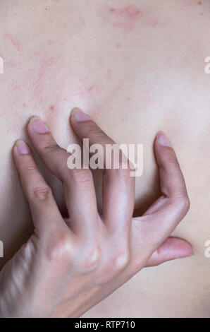 Akne, Dermatitis. Akne auf dem Rücken. Stockfoto