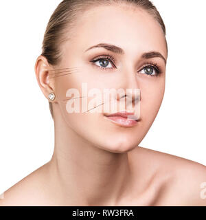 Junge weibliche Gesicht mit gesteckten Nadeln. Die Frau, die sich einer Akupunkturbehandlung Stockfoto