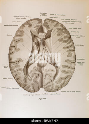 Dissektion des menschlichen Gehirns, Innenraum, graue Materie, Okzipitalen, Schläfen- und Scheitellappen. Stockfoto