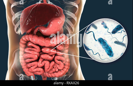 Cholera Infektion, Abbildung Stockfoto