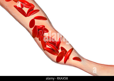 Blutgefäß in Sichelzellenanämie blockiert, Abbildung Stockfoto