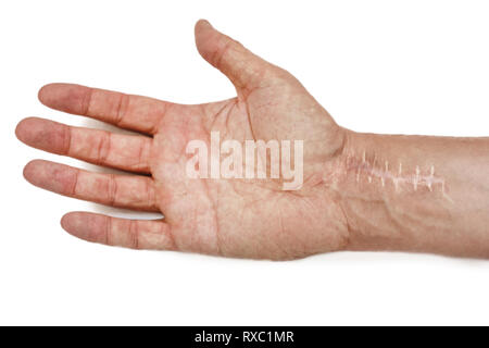 Narbe mit Stichen am Handgelenk nach der Operation. Bruch der Knochen der Hände auf weißem Hintergrund Stockfoto