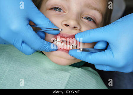 Kleines Mädchen auf die Prüfung zum Zahnarzt. Sie öffnete den Mund weit. Zahnarzt untersucht die Milchzähne. Vier oberen Zähne fehlen von Mädchen. Close-ups Stockfoto