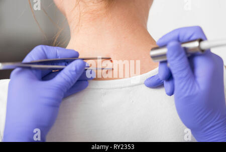 Muttermale Behandlung. Laser Mole Ausbau an der Klinik Stockfoto