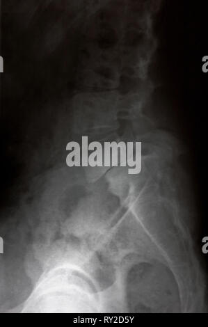 X-ray medizinische Bild-Backbone und Wirbel Stockfoto