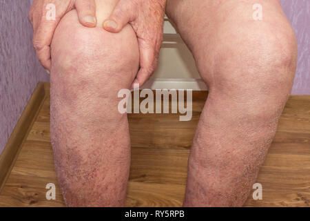 Älterer Mann, der das Knie mit Schmerzen. Collage. Konzept abstrakter Schmerz und Verzweiflung. Stockfoto