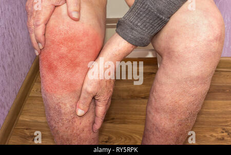 Älterer Mann, der das Knie mit Schmerzen. Collage. Konzept abstrakter Schmerz und Verzweiflung. Stockfoto