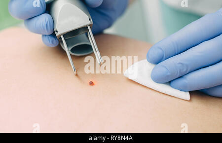 Patient, der eine Lasermole entfernt. Hautmolbehandlung. Stockfoto