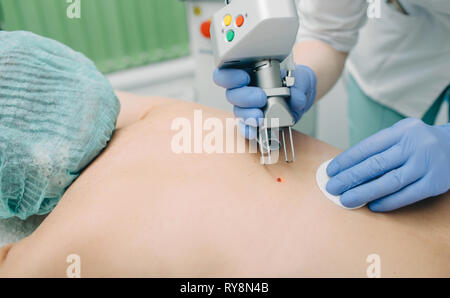 Patient, der eine Lasermole entfernt. Hautmolbehandlung. Stockfoto