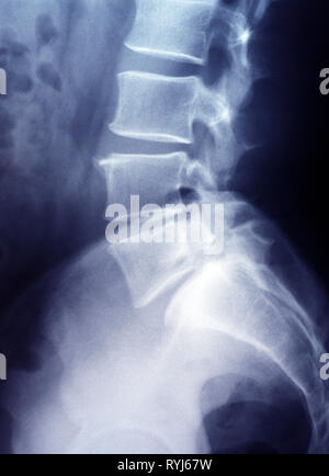 Lendenwirbelsäule x-ray film unteren Thorax Stockfoto