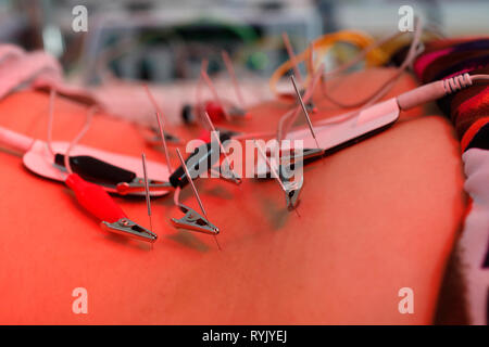 Vietnamesische traditionelle Medizin Klinik. Akupunktur Behandlung. Cu Chi. Vietnam. Stockfoto