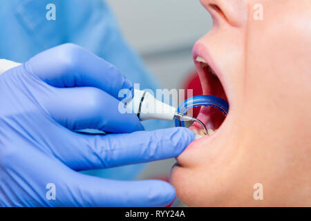 Entfernen der zahnmedizinischen Zahnstein. Stockfoto