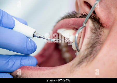 Entfernen der zahnmedizinischen Zahnstein. Stockfoto