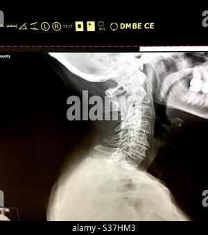 Röntgenaufnahme mit Halsarthritis des Halses. Stockfoto