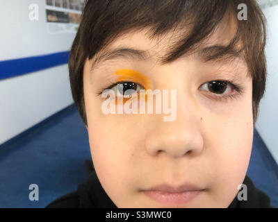 Ein Junge mit orangefarbenem Farbstoff im Auge, damit ein Arzt ordnungsgemäß nach Schäden an der Augenoberfläche suchen kann. Stockfoto