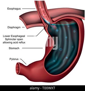 Esophagealsphincter Anatomie Reflux 3d medical Vector Illustration Stock Vektor
