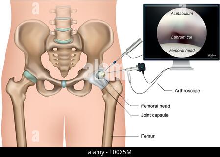 Hüftarthroskopie 3 d medical Vector Illustration auf weißem Hintergrund Stock Vektor