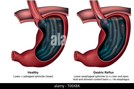 Gastric Reflux 3d medical Vector Illustration mit englischer Beschreibung Stock Vektor